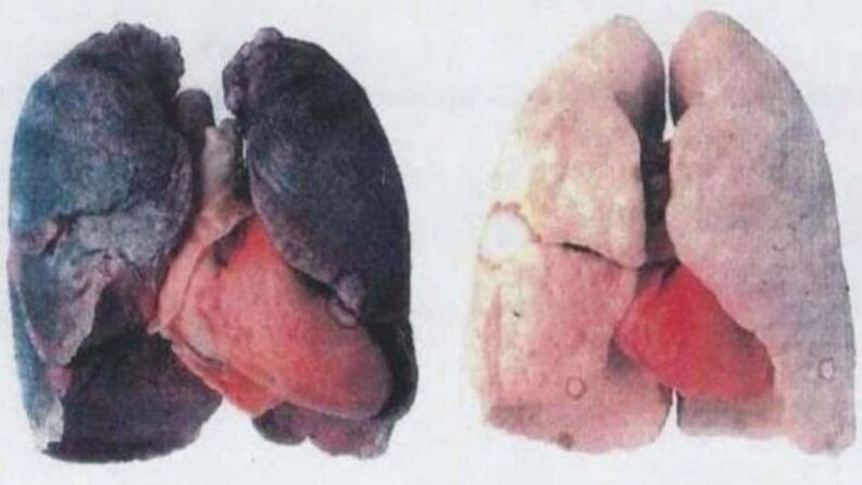 De nombreux alcooliques chroniques meurent en raison de lésions pulmonaires (à gauche)
