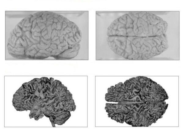 Le cerveau d'une personne en bonne santé (en haut) et le cerveau d'un alcoolique aux conséquences irréversibles (en bas)